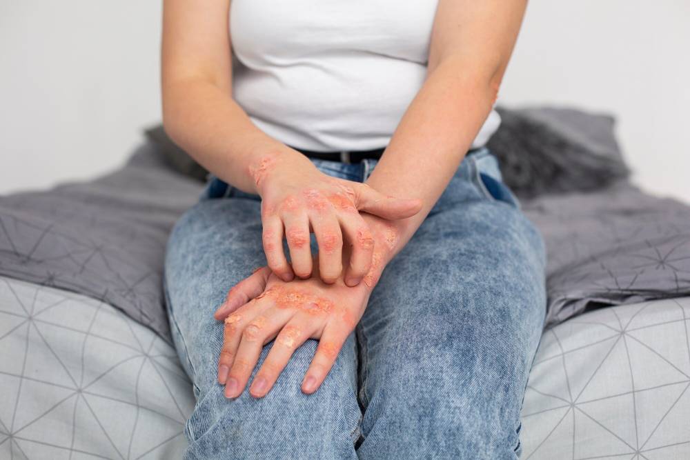 Eczema Treatment