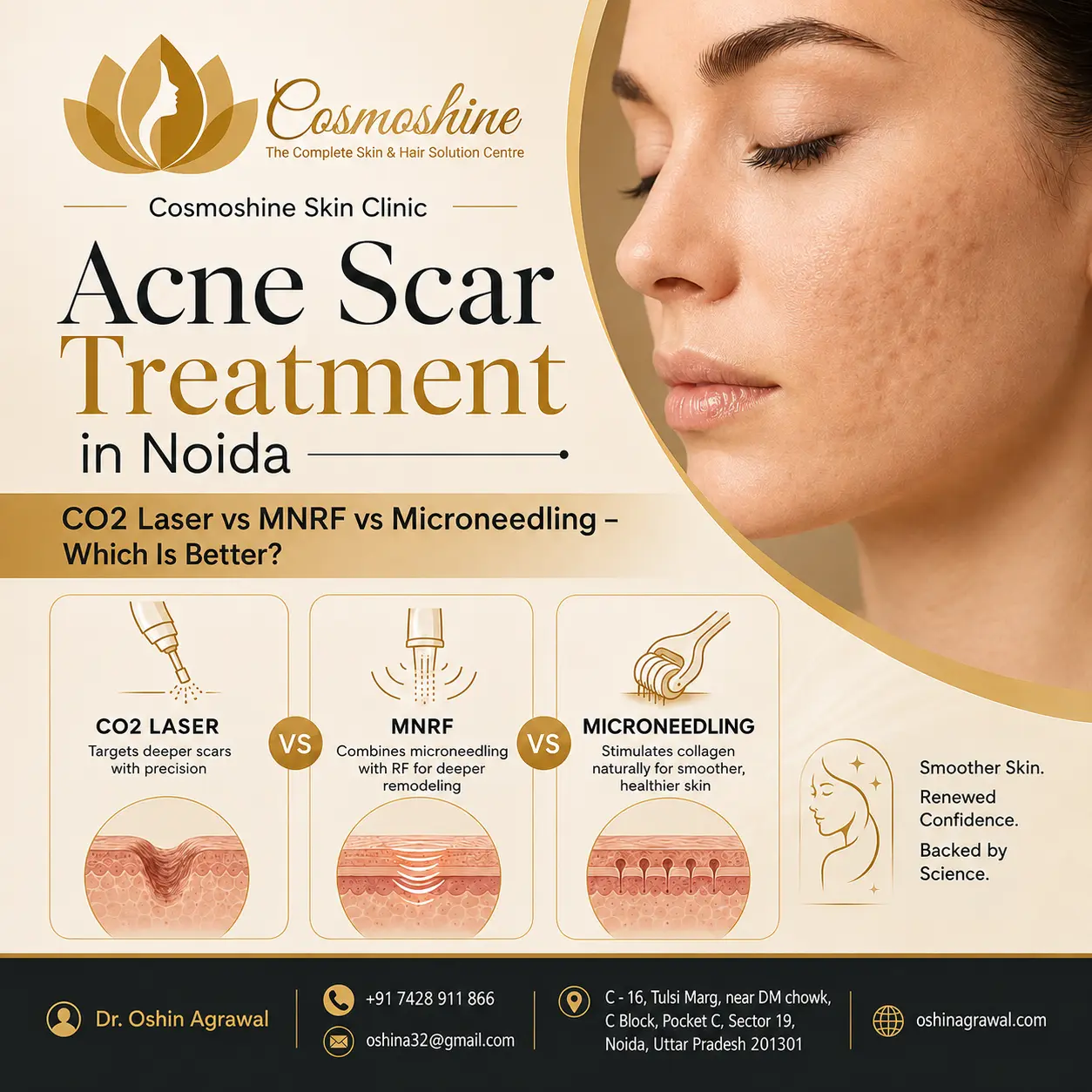 Acne scar treatment in Noida