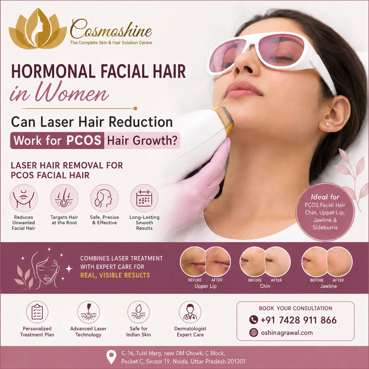 laser hair removal for PCOS facial hair